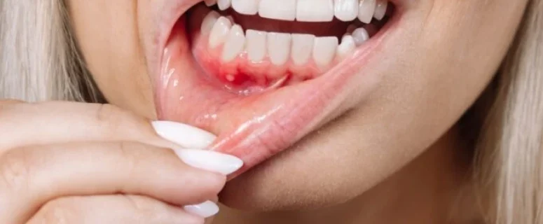 Can Stress Cause Periodontal Disease?